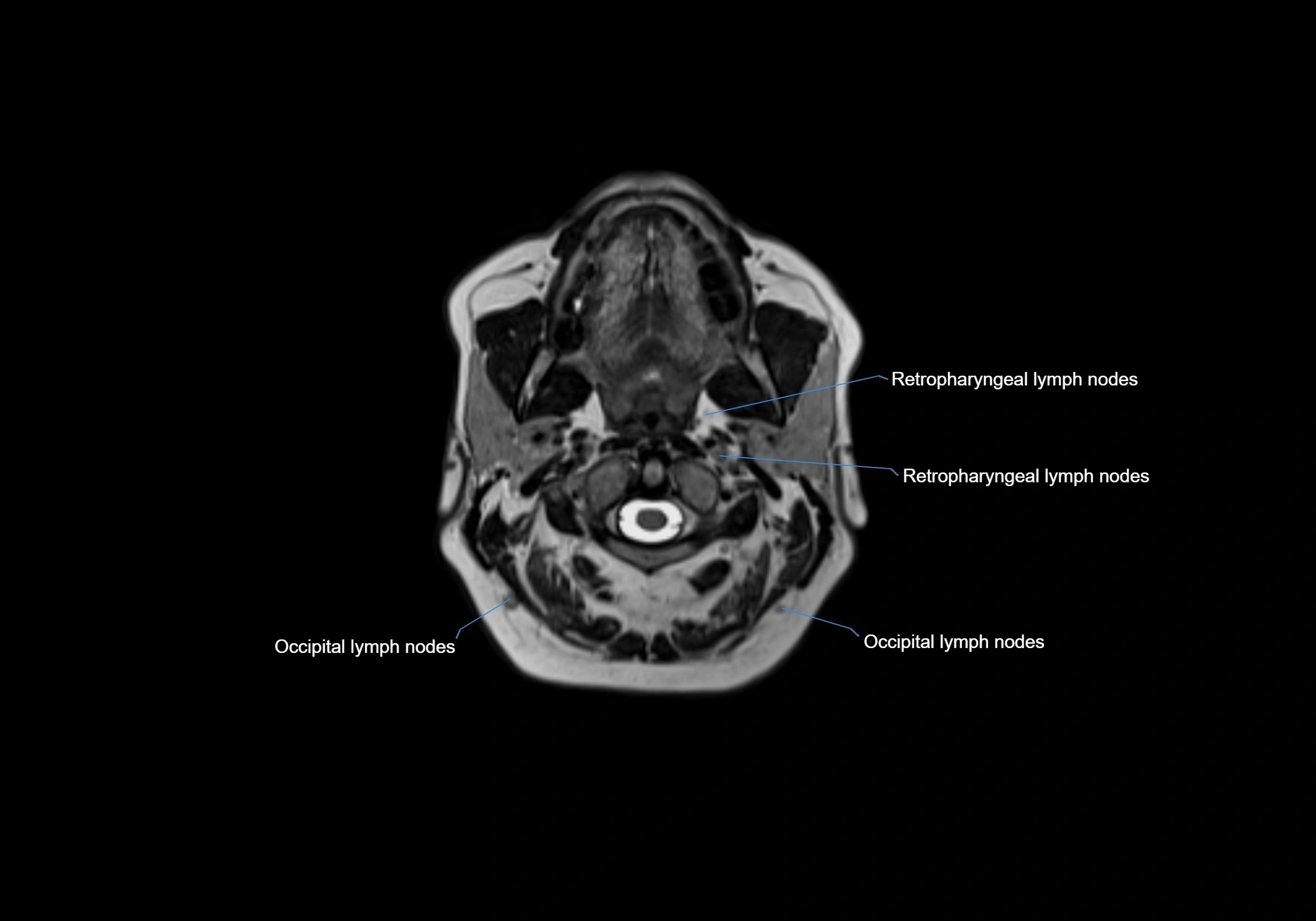 Neck axial  lymph node cross sectional MRI anatomy 3T MRI  image-img-00001-00034.webp